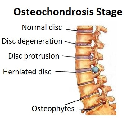 Cervical osteochondrosis: symptoms, signs