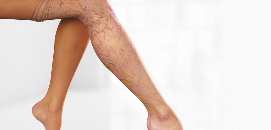 Causes of varicose veins the fight against varicose veins